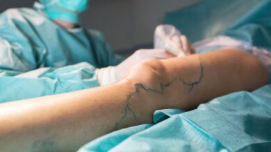 Für die Behandlung von Krampfadern gibt es unterschiedliche Methoden. In den meisten Fällen kann diese ambulant erfolgen. Aber es gibt Ausnahmen.