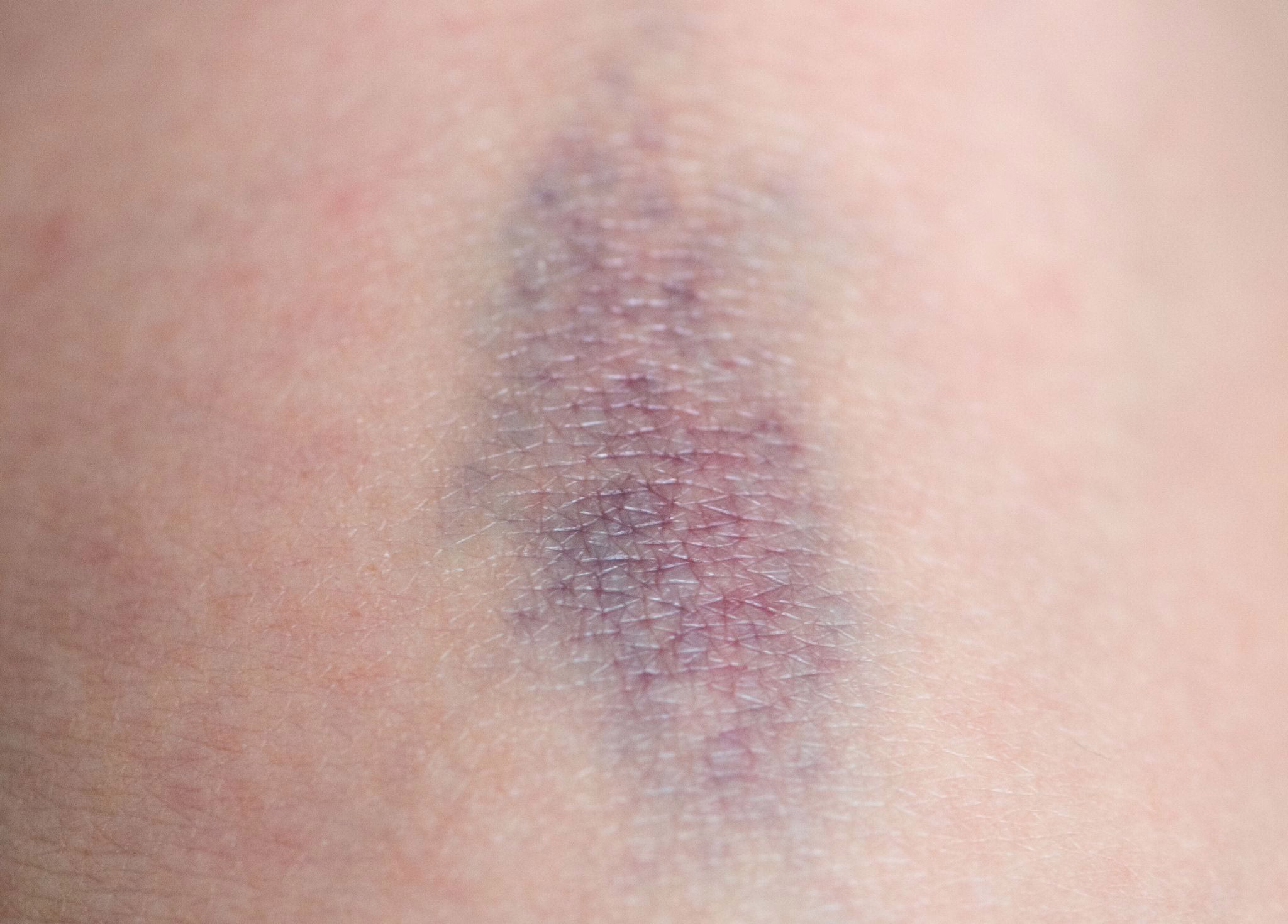Ein Bluterguss Auf Einem Knie