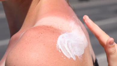 Eine Frau Trägt Creme Auf Einen Sonnenbrand Auf