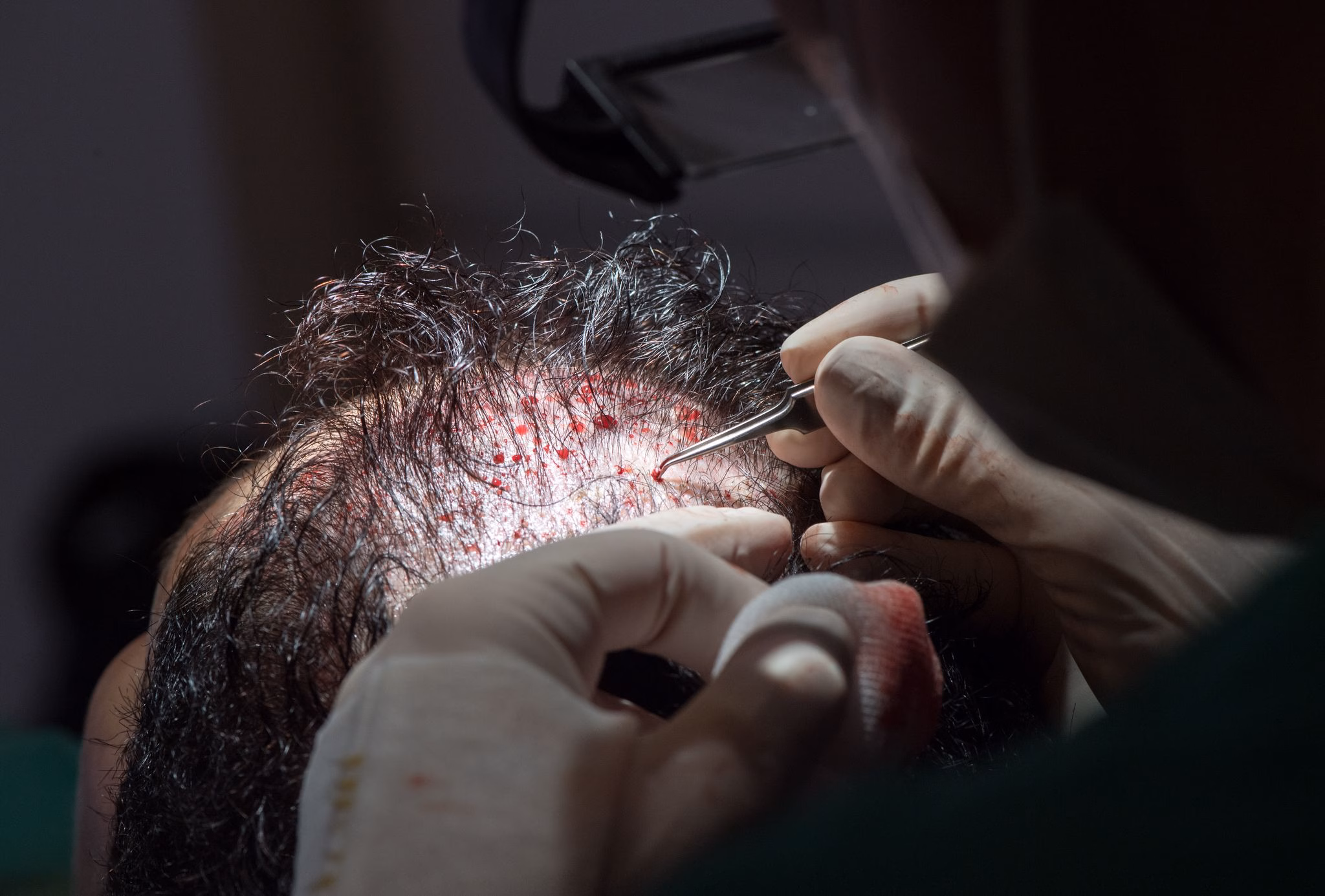 Haartransplantation nach der fut methode bei einer patientin